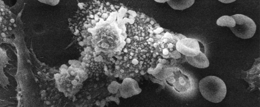 Image of macrophages beginning to fuse with, and inject toxins into, a cancer cell. The cell starts rounding up and loses its spikes.