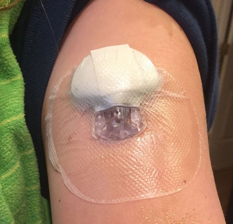 Photo of sensor in Jamie’s upper arm which monitors her glucose levels and communicates the data to her insulin pump. Sensor is small and attached with clear medical adhesive, with cotton material at the top.