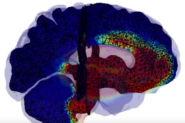 Screenshot from video showing model of the brain wiht multicolored overlay representing spread of neurodegenerative disease.