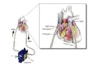 An illustration depicting the bridge-to-transplant system.
