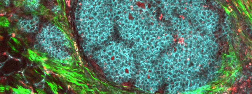 Image with large central turquoise-blue area surrounded by green, speckled by red cancer cells.