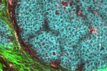 Image with large central turquoise-blue area surrounded by green, speckled by red cancer cells.