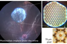 Images of Dr. Daniel Palanker's retinal implant.