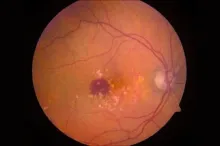 Image of eye affected by AMD.