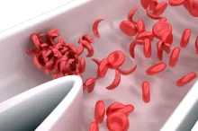 Graphic image of sickle cell blood cells in a vessel.