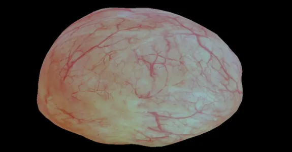 Screenshot from video of 3D bladder reconstruction.