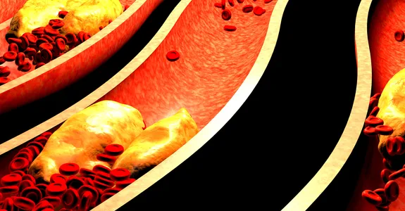 Graphic image depicting plaques clogging arteries.