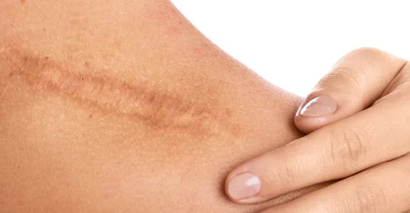 Photo of a person laying their hand on their shoulder next to a large scar.