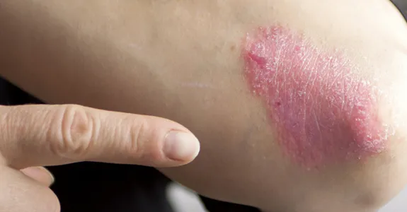 Photo of skin affected by psoriasis.