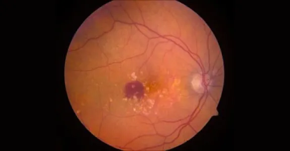 Image of eye affected by AMD.