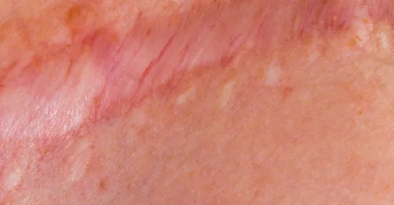 Photo of scar tissue.
