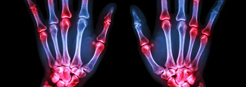 Graphic image depicting arthritis pain in hand joints.