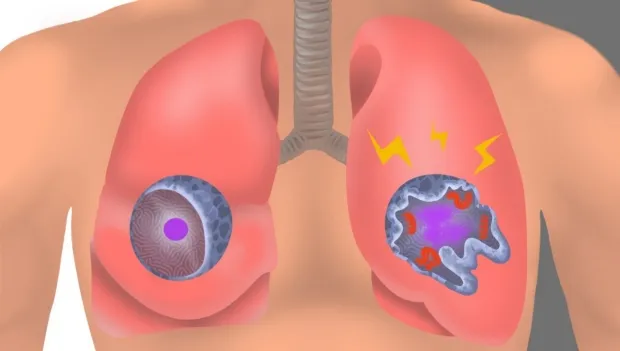Graphic illustration showing lungs with inflamed oversized cells.