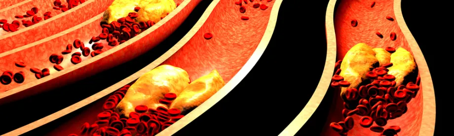 Graphic image depicting plaques clogging arteries.