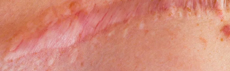 Photo of scar tissue.
