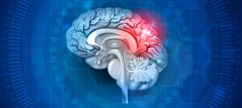 Graphic image of a human brain with one part highlighted in red to indicate stroke or damage.